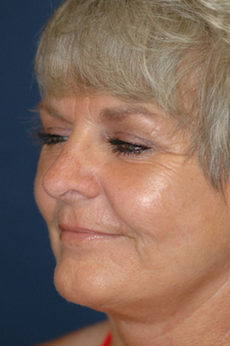 Facelift Before & After Gallery - Patient 130851 - Image 4