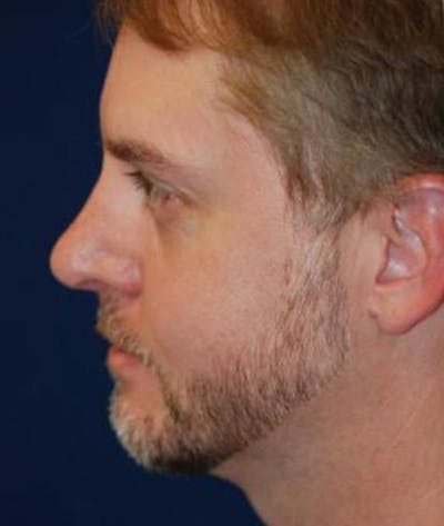 Rhinoplasty Before & After Gallery - Patient 320570 - Image 2