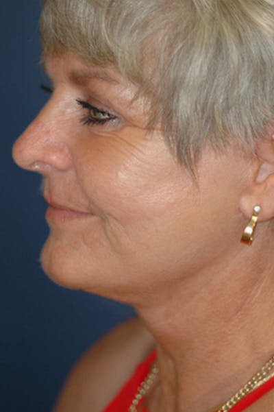 Facelift Before & After Gallery - Patient 130851 - Image 2