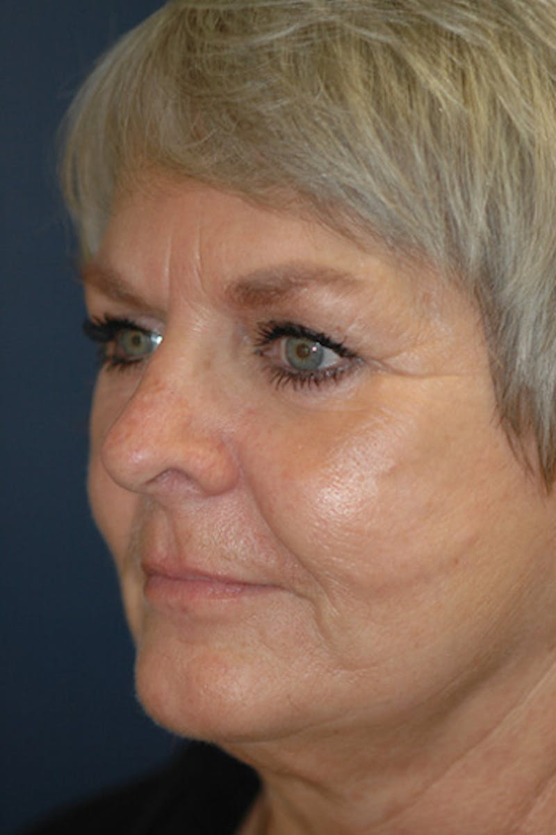 Facelift Before & After Gallery - Patient 130851 - Image 3