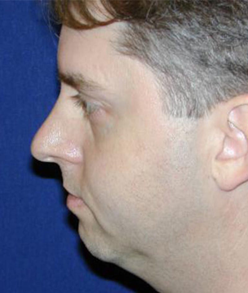 Chin Augmentation Before & After Gallery - Patient 570413 - Image 3