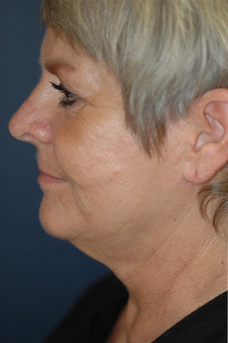 Facelift Before & After Gallery - Patient 130851 - Image 1