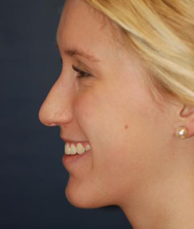 Rhinoplasty Before & After Gallery - Patient 380470 - Image 5