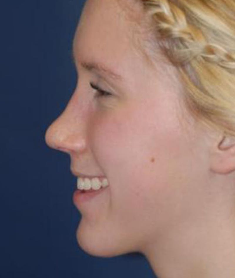 Rhinoplasty Before & After Gallery - Patient 380470 - Image 6