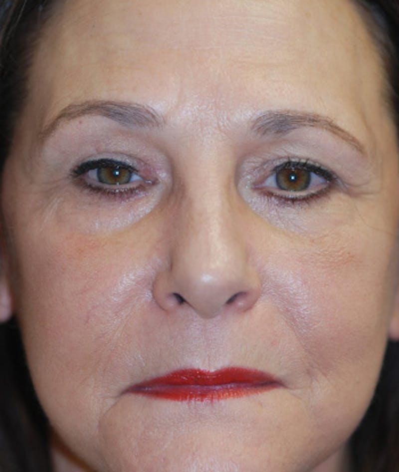Facelift Before & After Gallery - Patient 113580 - Image 2