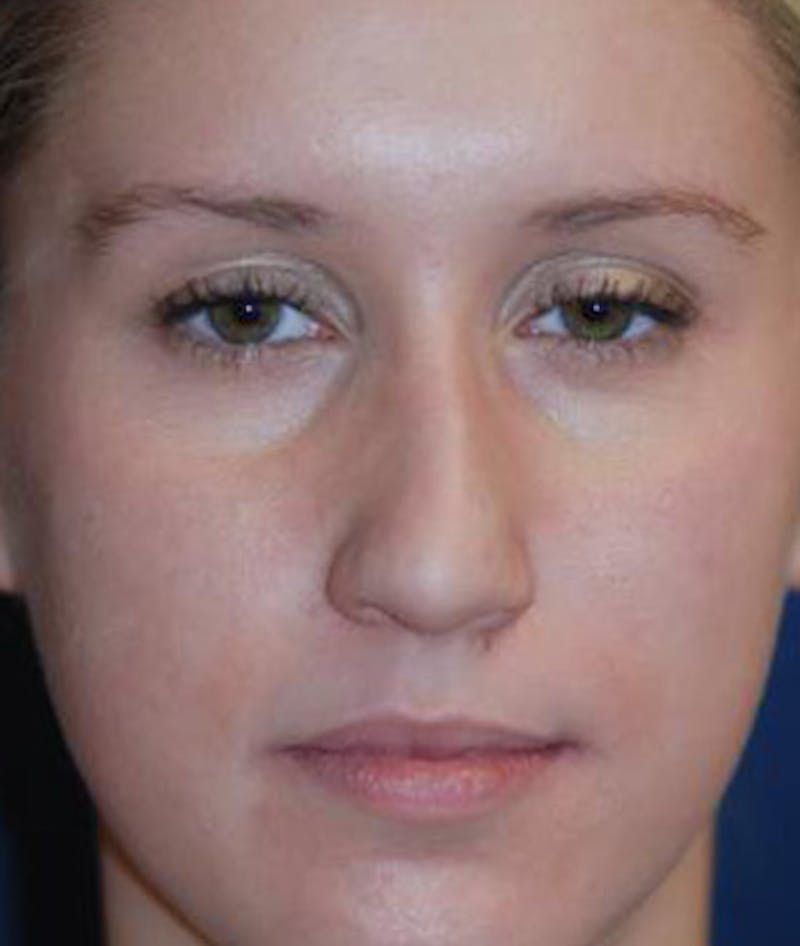 Rhinoplasty Before & After Gallery - Patient 380470 - Image 3