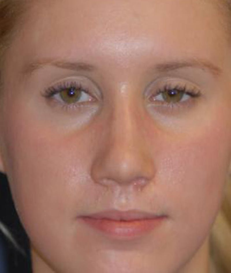 Rhinoplasty Before & After Gallery - Patient 380470 - Image 4