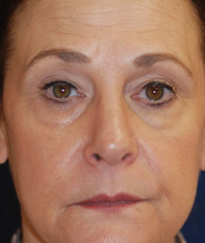Facelift Before & After Gallery - Patient 113580 - Image 1