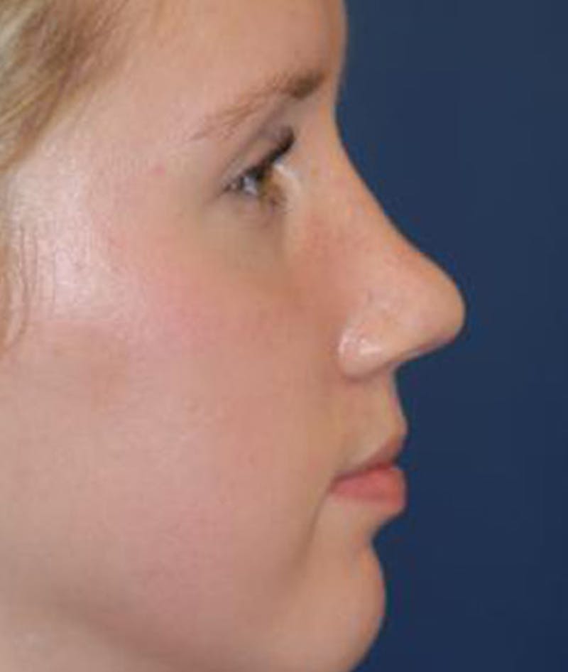 Rhinoplasty Before & After Gallery - Patient 380470 - Image 2