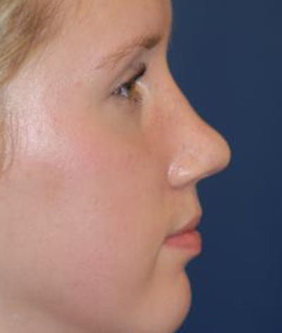 Rhinoplasty Before & After Gallery - Patient 380470 - Image 2