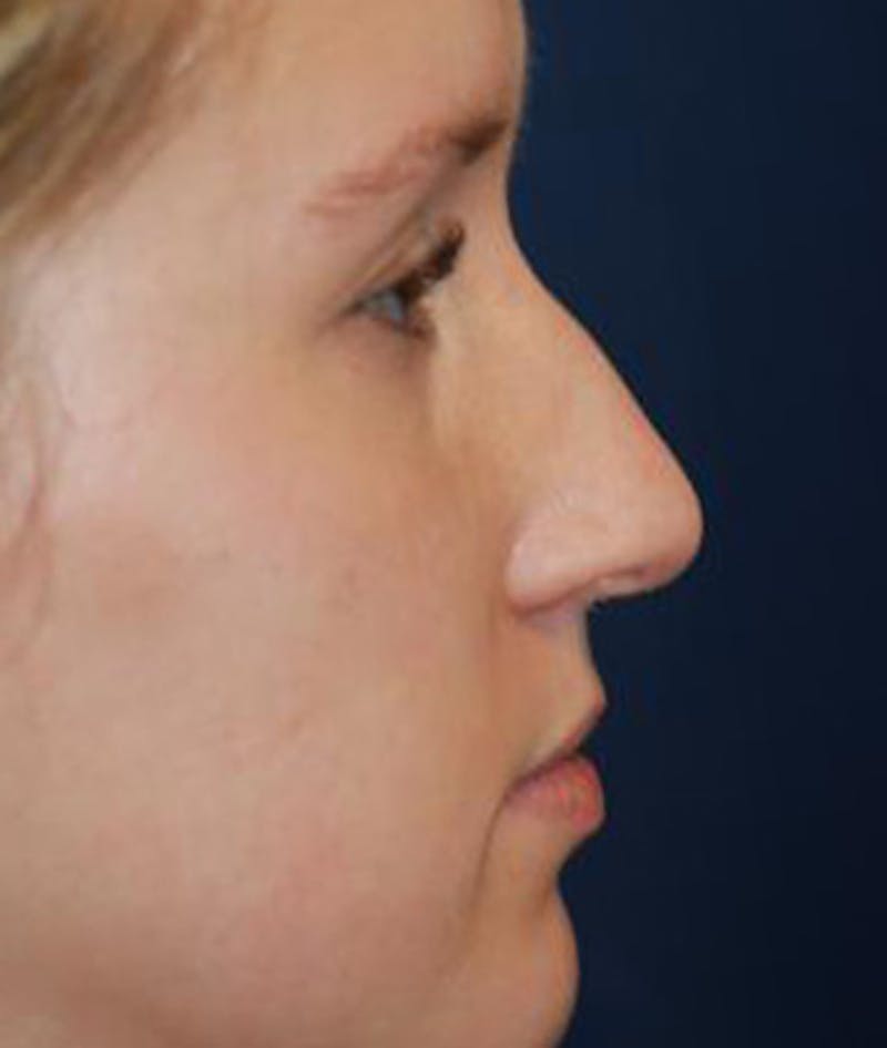 Rhinoplasty Before & After Gallery - Patient 380470 - Image 1