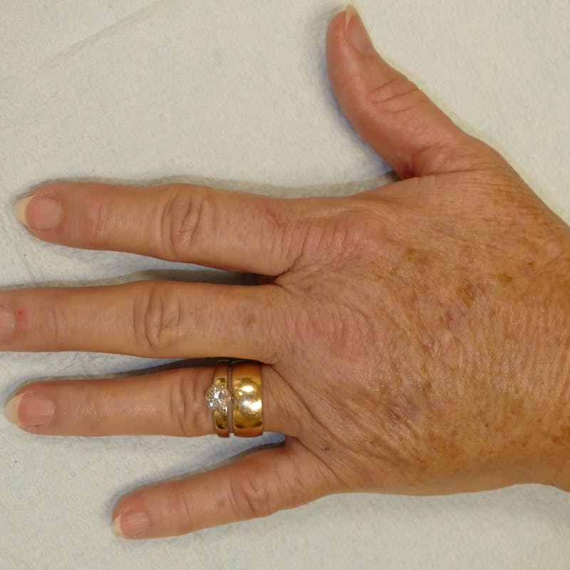 Hand Rejuvenation Before & After Gallery - Patient 240307 - Image 4