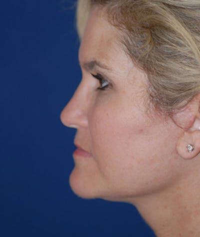 Facelift Before & After Gallery - Patient 756685 - Image 2