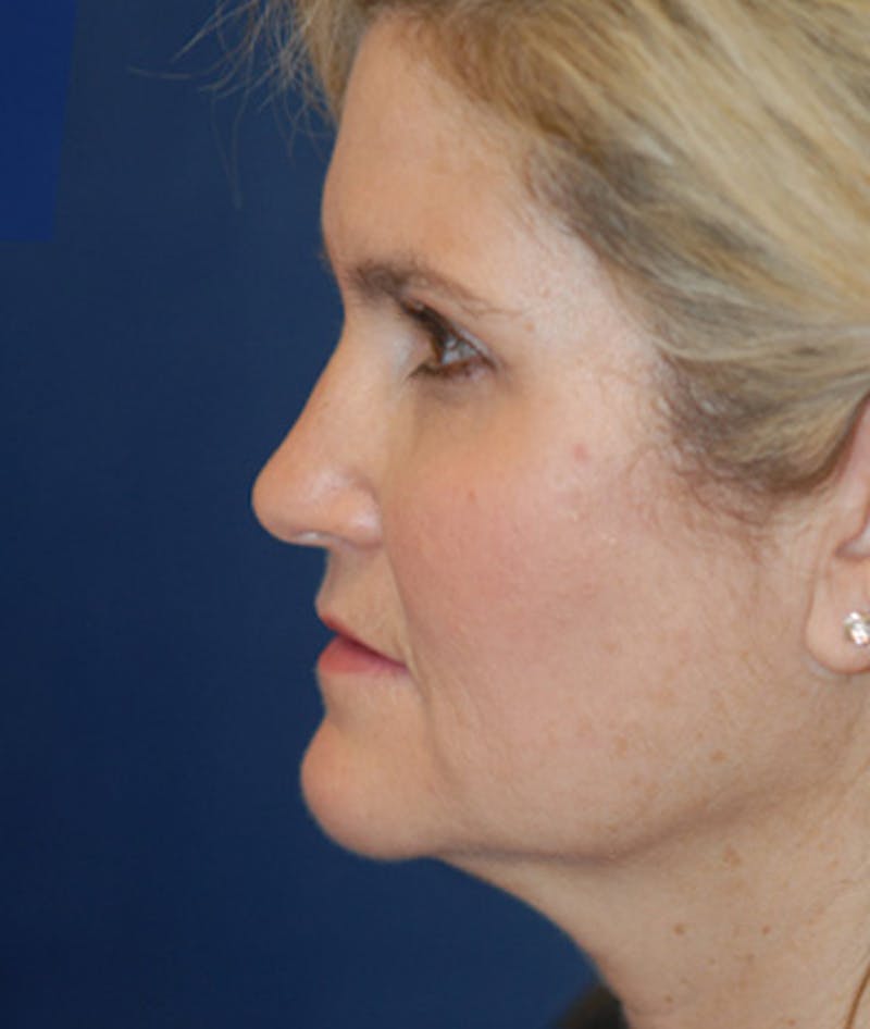 Facelift Before & After Gallery - Patient 756685 - Image 1