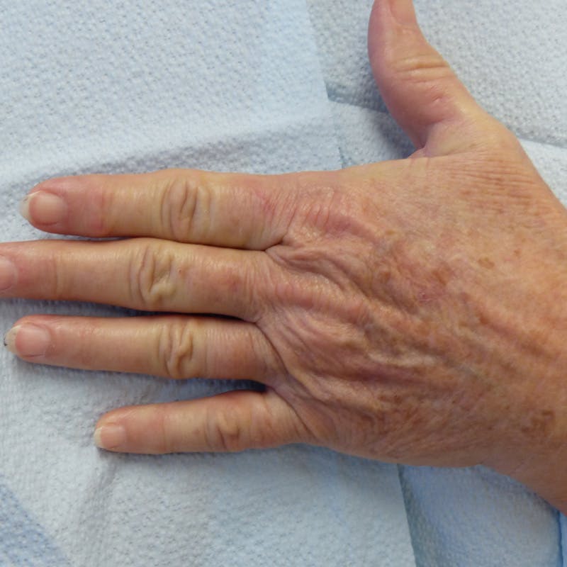 Hand Rejuvenation Before & After Gallery - Patient 240307 - Image 3