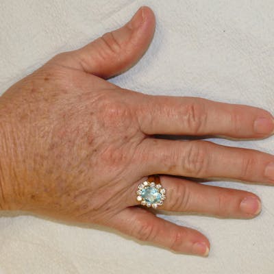 Hand Rejuvenation Before & After Gallery - Patient 240307 - Image 2