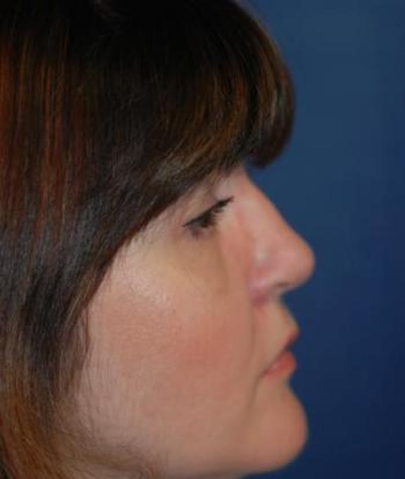Rhinoplasty Before & After Gallery - Patient 163129 - Image 6