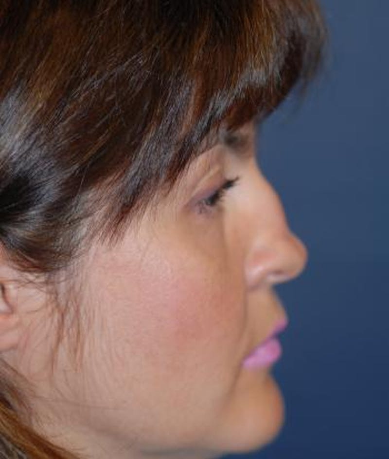 Rhinoplasty Before & After Gallery - Patient 163129 - Image 5