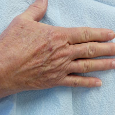Hand Rejuvenation Before & After Gallery - Patient 240307 - Image 1