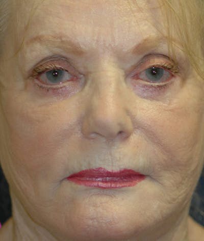 Facelift Before & After Gallery - Patient 534074 - Image 2