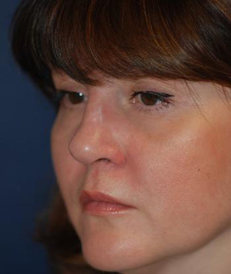 Rhinoplasty Before & After Gallery - Patient 163129 - Image 4