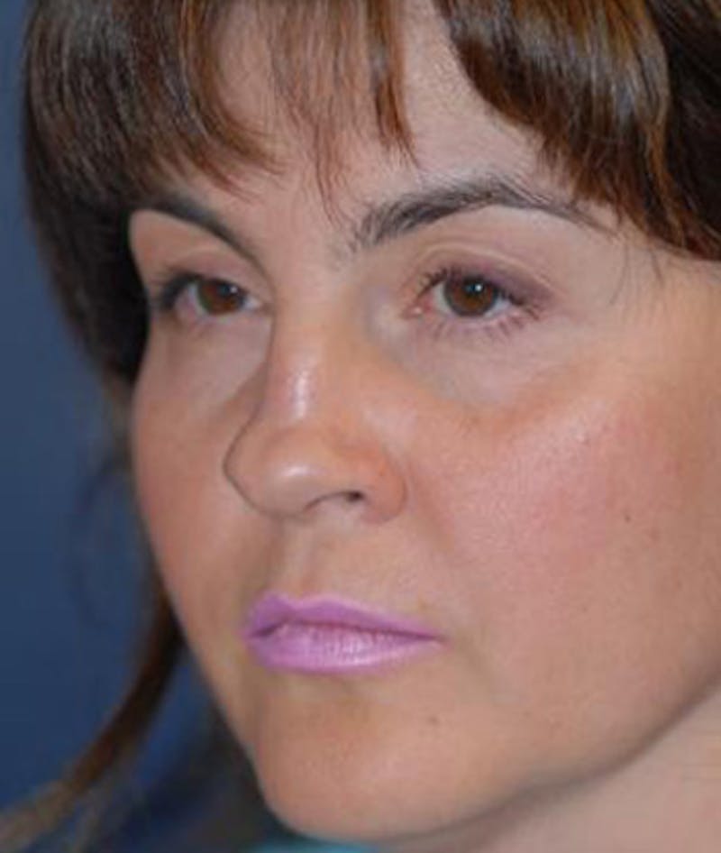 Rhinoplasty Before & After Gallery - Patient 163129 - Image 3