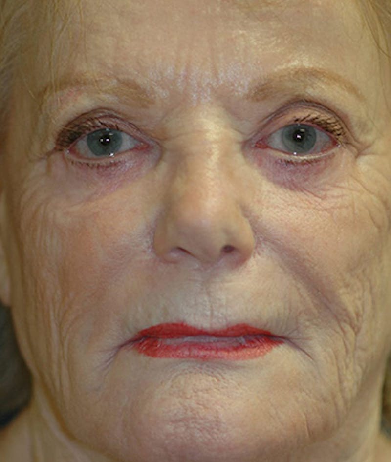 Facelift Before & After Gallery - Patient 534074 - Image 1