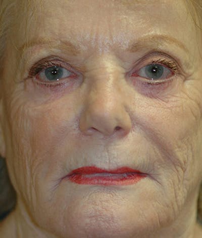 Facelift Before & After Gallery - Patient 534074 - Image 1
