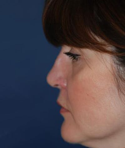 Rhinoplasty Before & After Gallery - Patient 163129 - Image 2