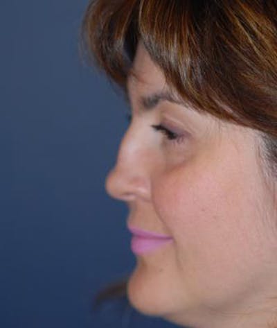 Rhinoplasty Before & After Gallery - Patient 163129 - Image 1