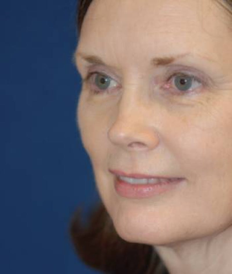 Facelift Before & After Gallery - Patient 246610 - Image 7