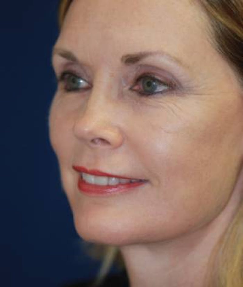 Facelift Before & After Gallery - Patient 246610 - Image 8