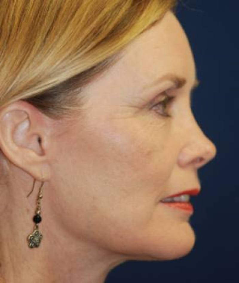 Facelift Before & After Gallery - Patient 246610 - Image 6