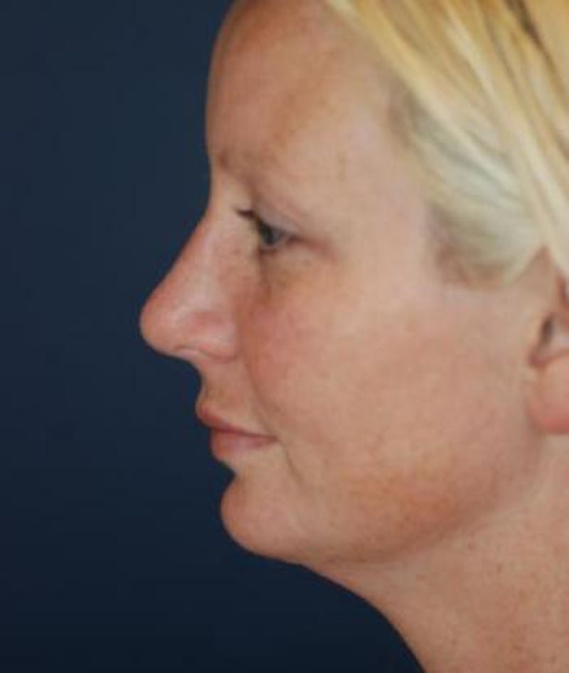 Chin Augmentation Before & After Gallery - Patient 135184 - Image 4