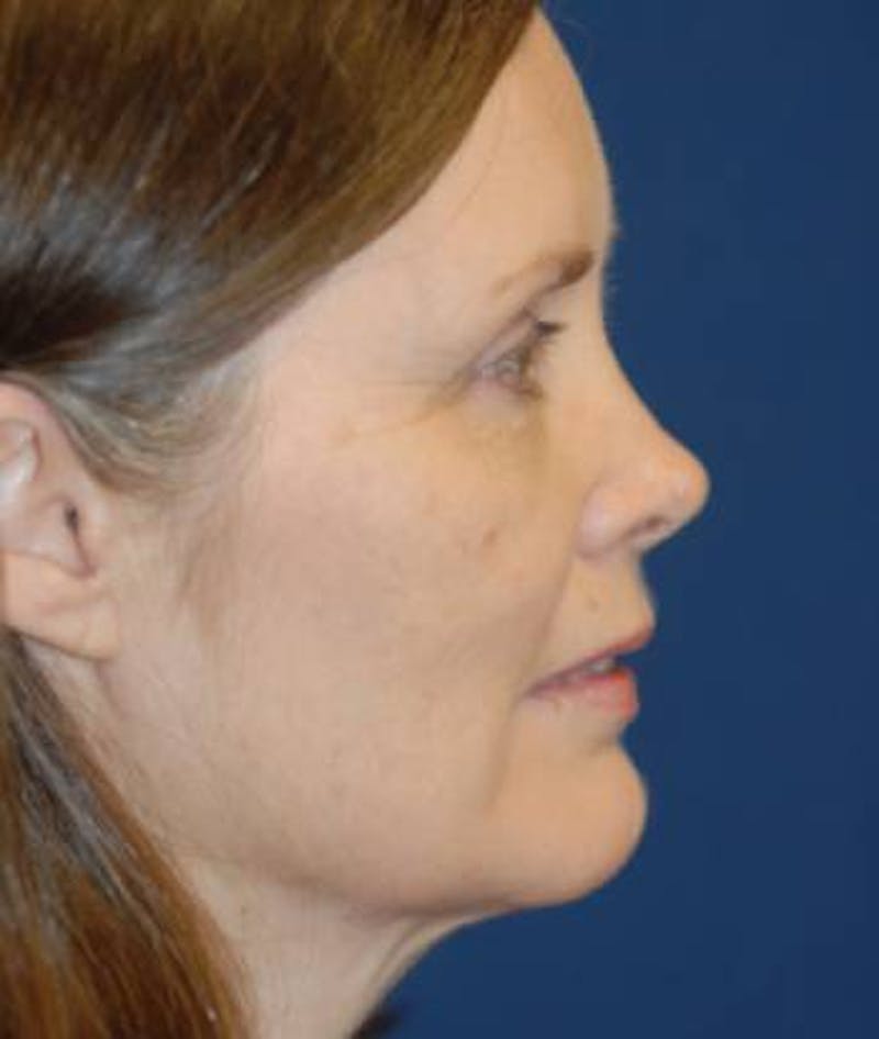 Facelift Before & After Gallery - Patient 246610 - Image 5