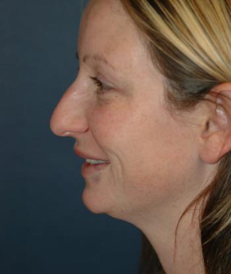 Rhinoplasty Before & After Gallery - Patient 417206 - Image 5