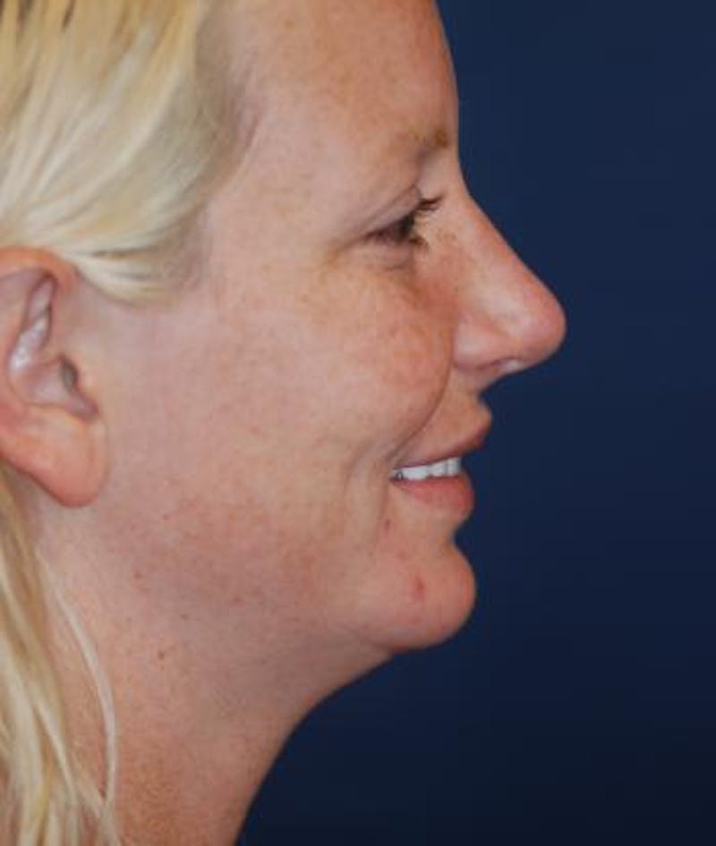 Chin Augmentation Before & After Gallery - Patient 135184 - Image 2