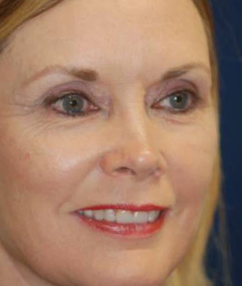 Facelift Before & After Gallery - Patient 246610 - Image 4