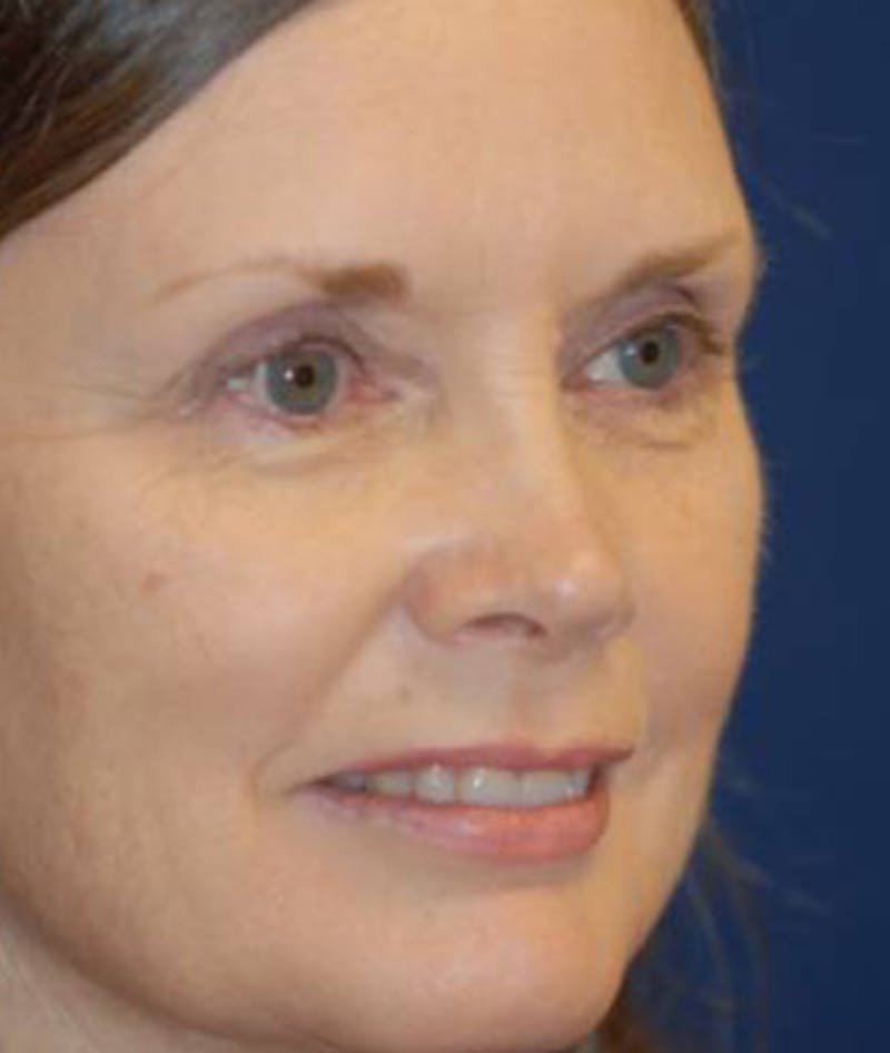 Facelift Before & After Gallery - Patient 246610 - Image 3