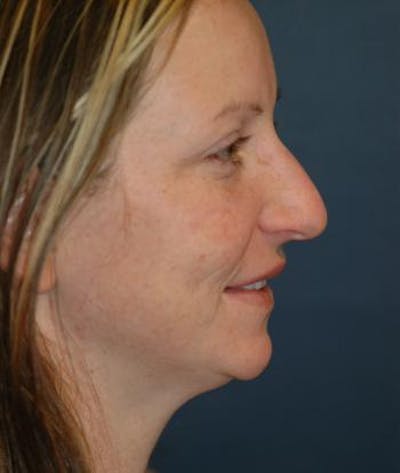 Chin Augmentation Before & After Gallery - Patient 135184 - Image 1