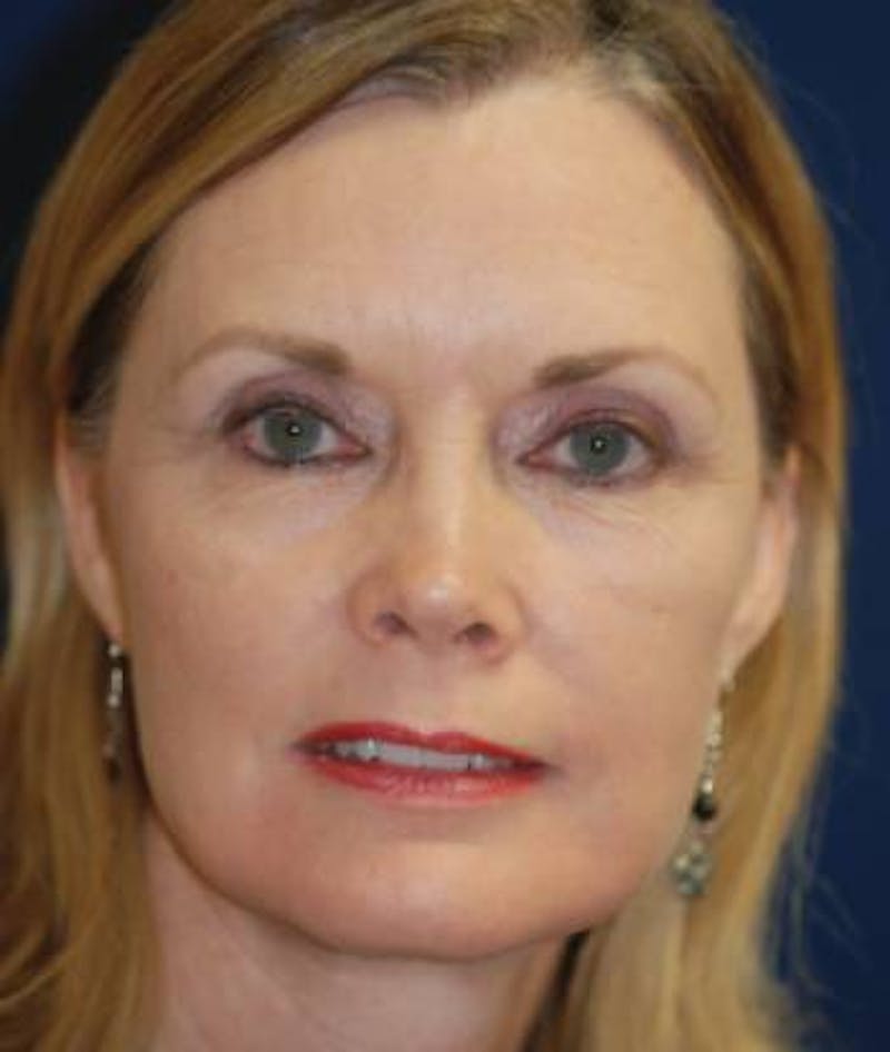 Facelift Before & After Gallery - Patient 246610 - Image 2