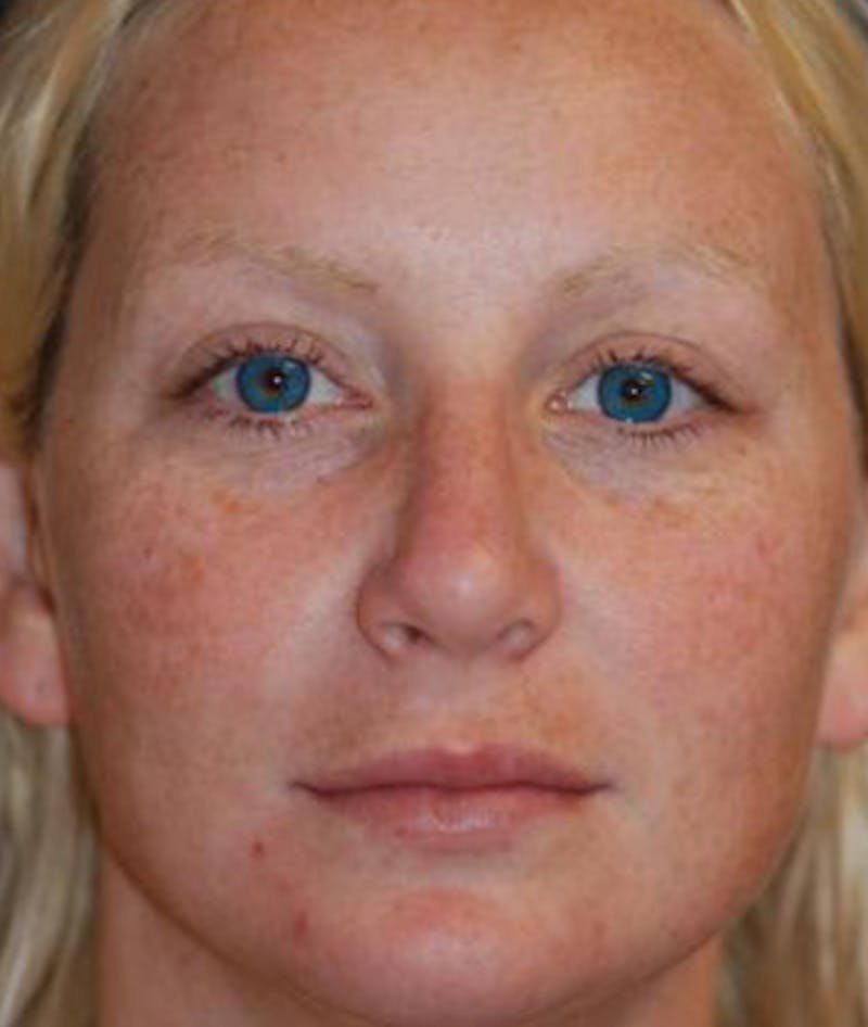 Rhinoplasty Before & After Gallery - Patient 417206 - Image 2