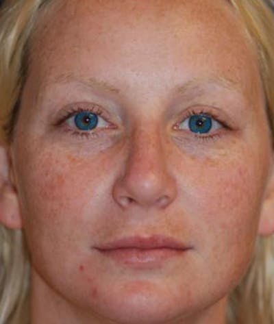Rhinoplasty Before & After Gallery - Patient 417206 - Image 2