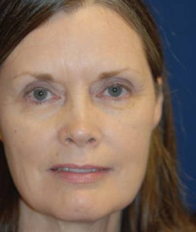 Facelift Before & After Gallery - Patient 246610 - Image 1