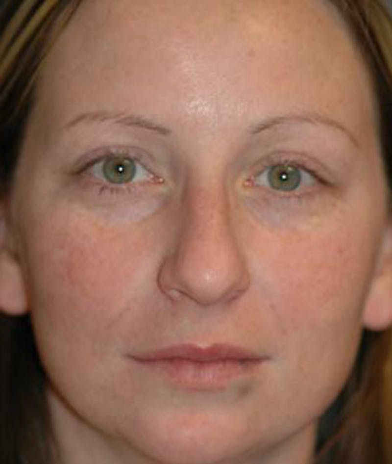 Rhinoplasty Before & After Gallery - Patient 417206 - Image 1
