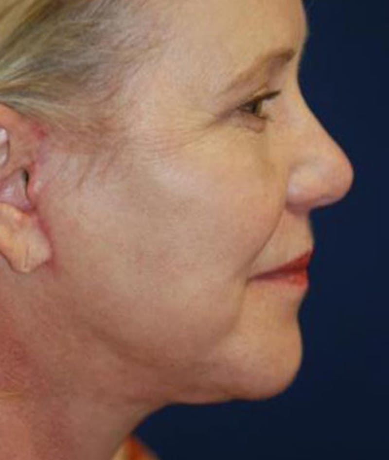 Facelift Before & After Gallery - Patient 198541 - Image 4