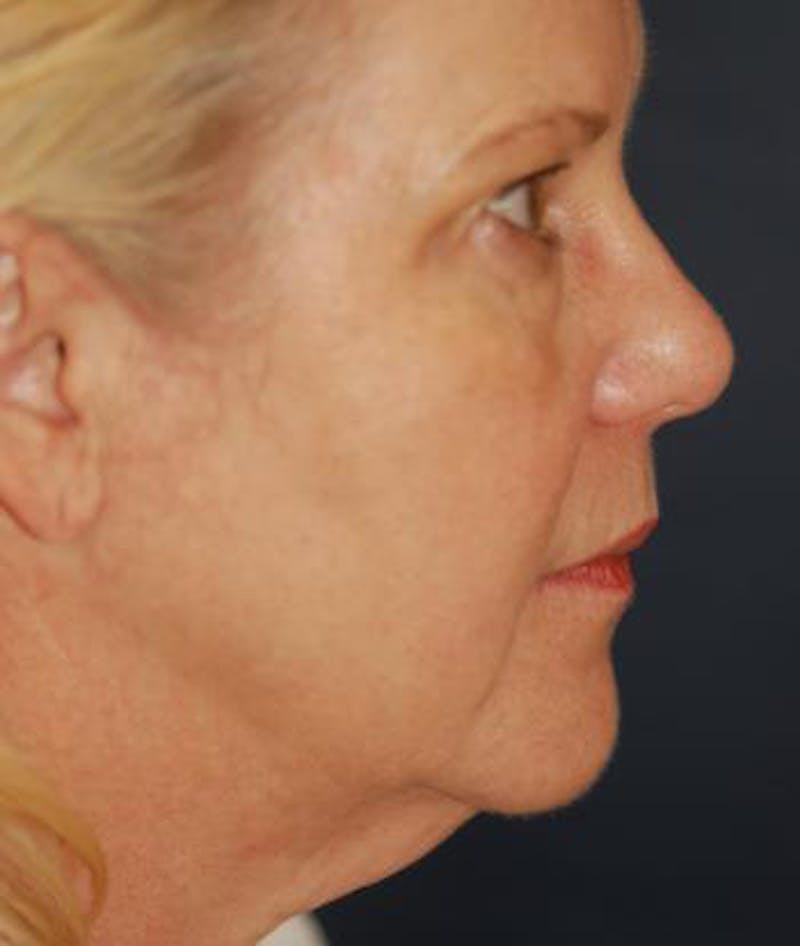 Facelift Before & After Gallery - Patient 198541 - Image 3