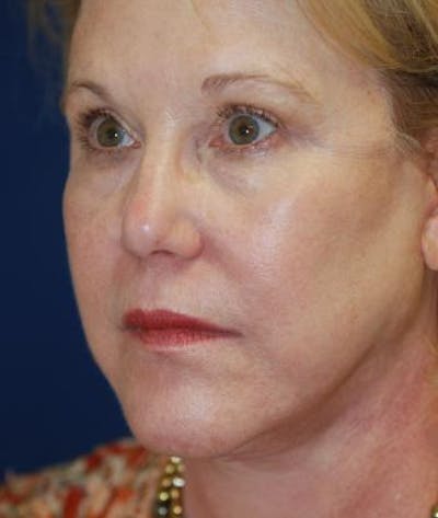 Facelift Before & After Gallery - Patient 198541 - Image 2