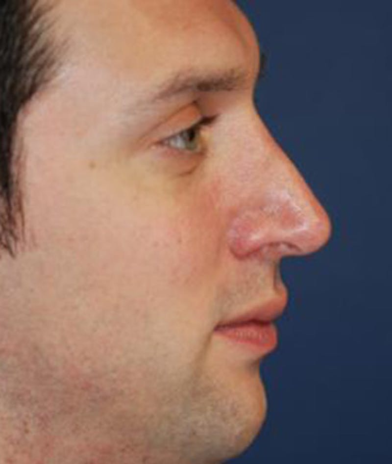 Rhinoplasty Before & After Gallery - Patient 375556 - Image 6