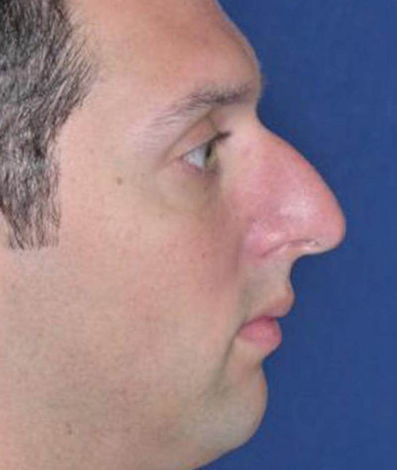 Rhinoplasty Before & After Gallery - Patient 375556 - Image 5